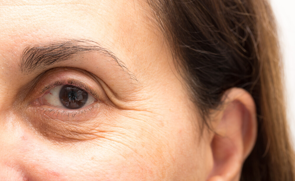 عوامل ایجاد چروک و سیاهی دور چشم